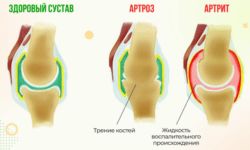 Артровекс защищает хрящи и суставы от артрита
