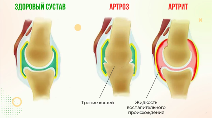 Артровекс защищает хрящи и суставы от артрита